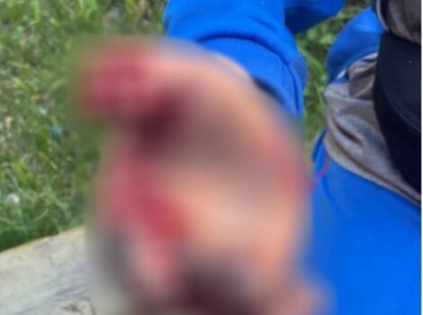 У Павлограді дитина постраждала від вибуху невідомого предмета в руках
